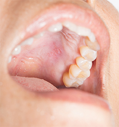 mercury free fillings ocala