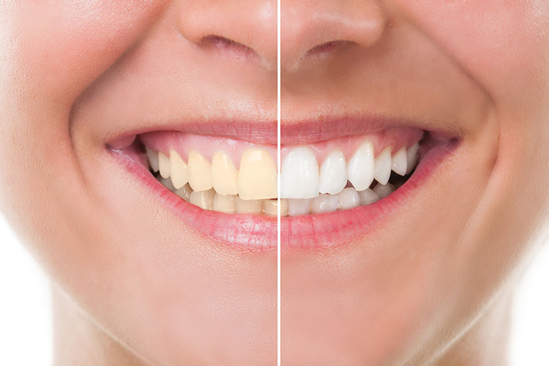 smart smile cosmetic teeth whitening